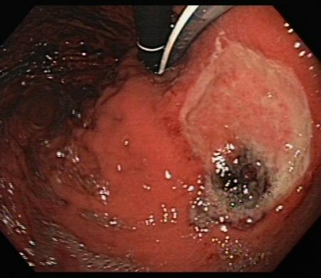 რა ახორცებს სწრაფად კუჭის წყლულს ენდოსკოპიით გადაღებული კუჭის წყლული